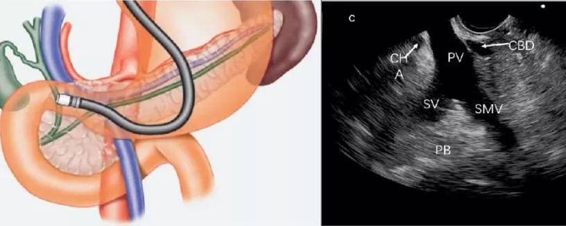 消化内镜医生的第三只眼,超声内镜到底有多牛?_病变
