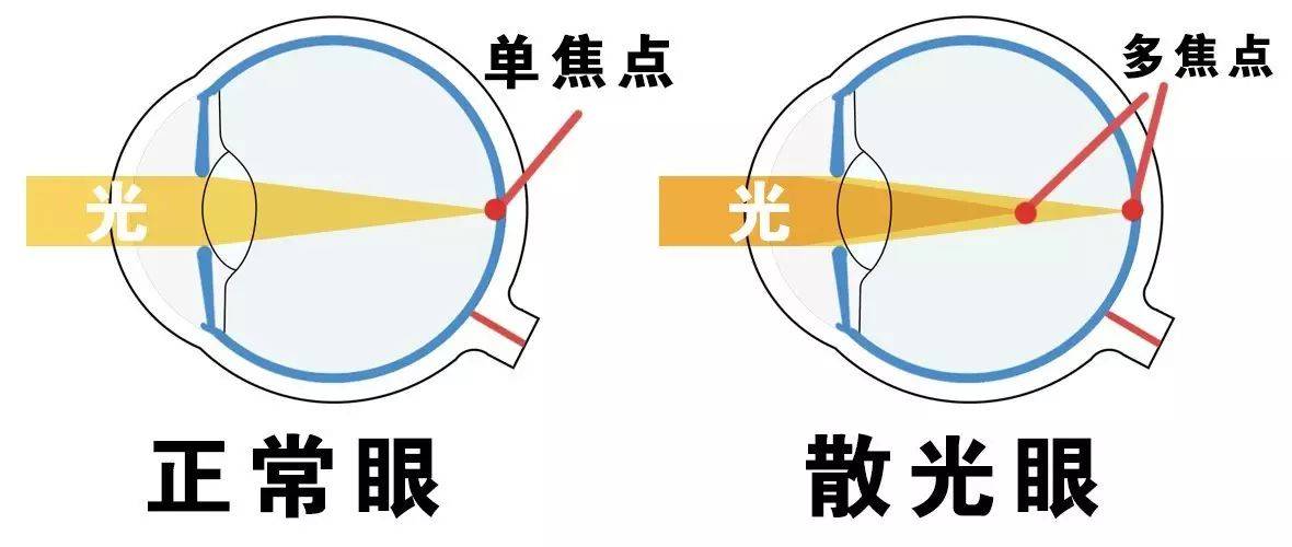 散光的这几个常识问题,了解后才不心慌_度数