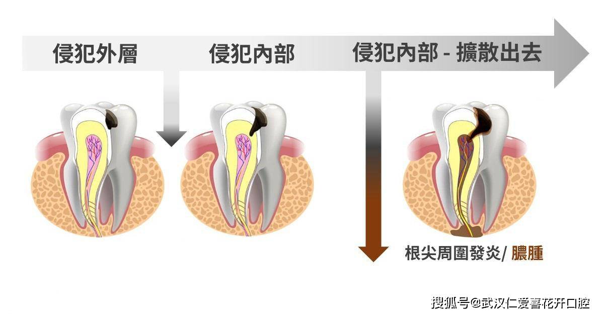 別再說牙痛不是病了,這個病真的會毀