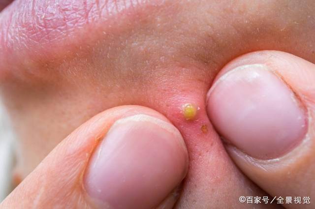 阳性反应常在24小时左右在针眼处发生毛囊炎样小红点或脓疱,48小时