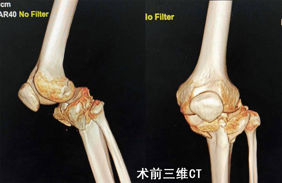 山东省泰安市中心医院 3d打印助力急诊外科复杂胫骨平台骨折手术 患者