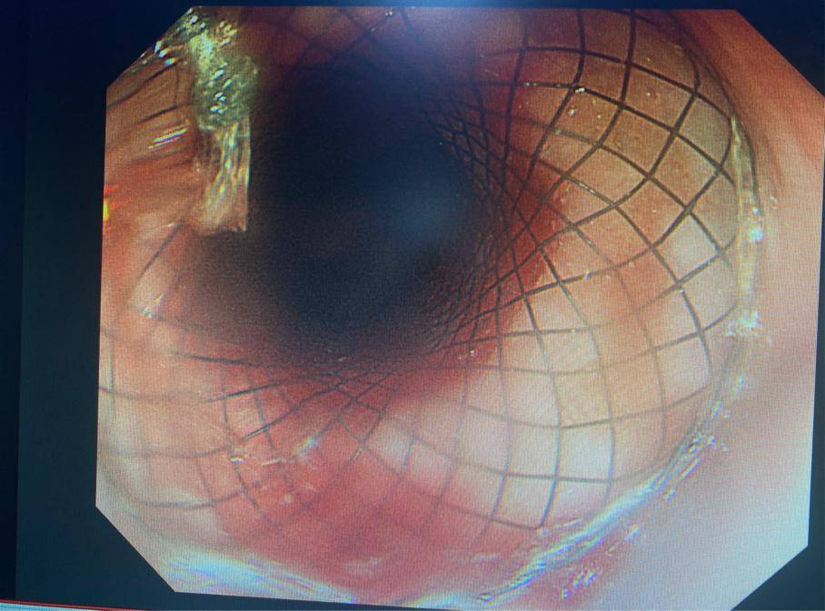 太原市第七人民医院成功完成首例内镜下食管支架植入术