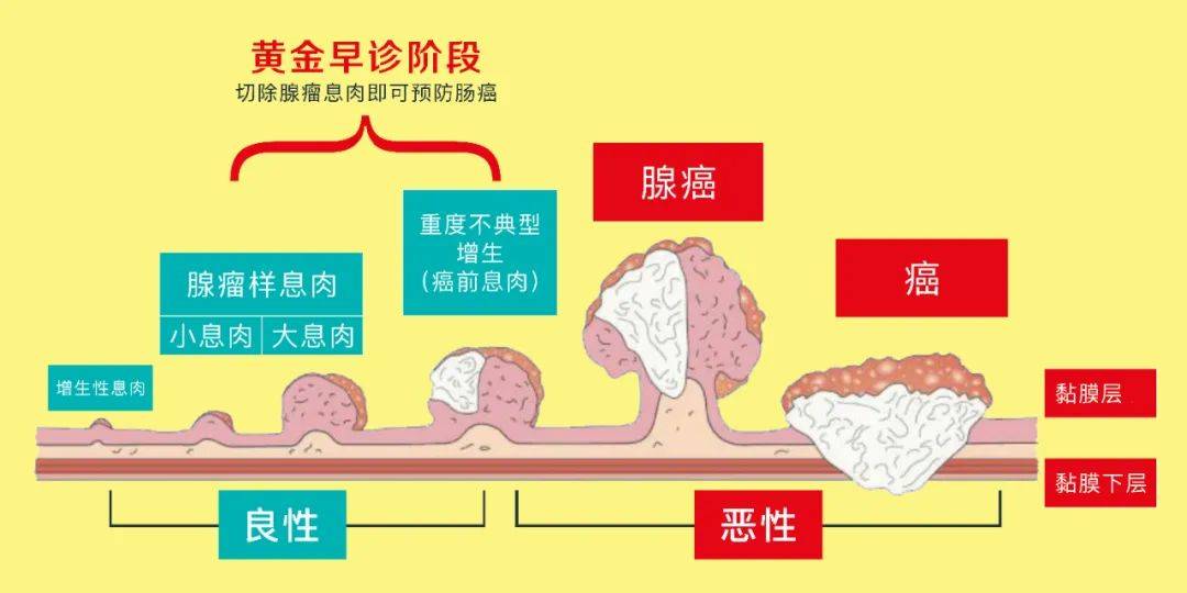 早期肠癌治疗5年生存率可超过95 检查