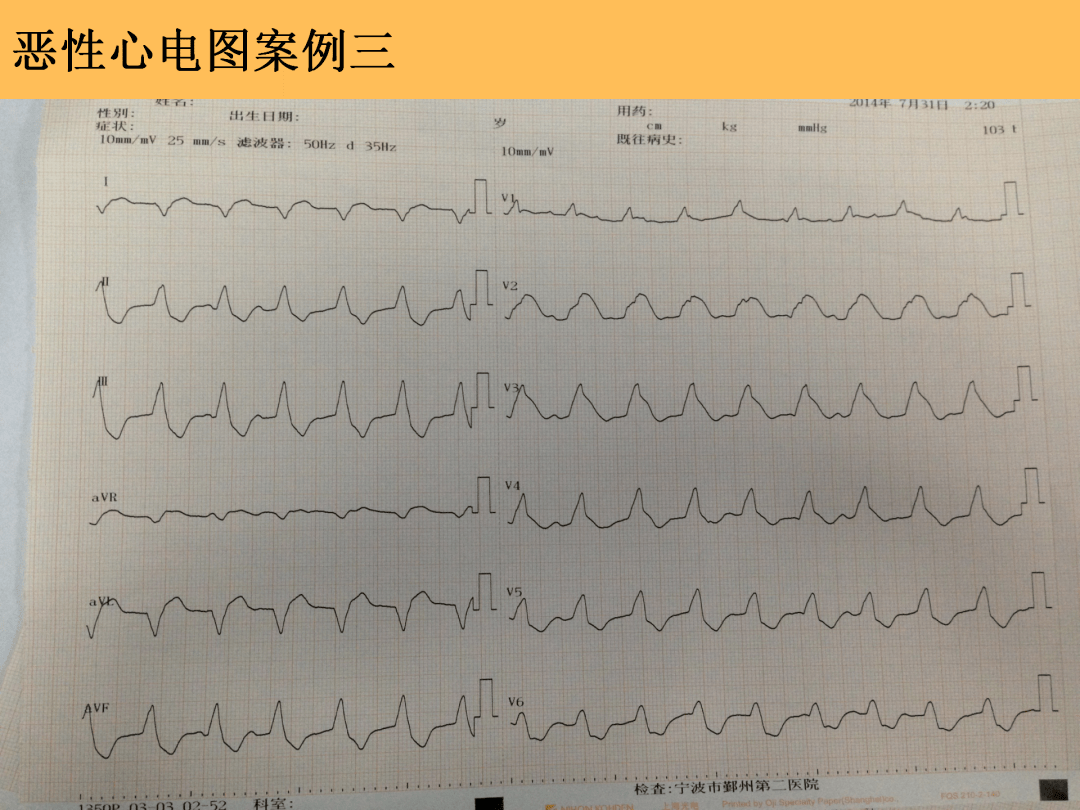 惡性心律失常心電圖的識別與處理