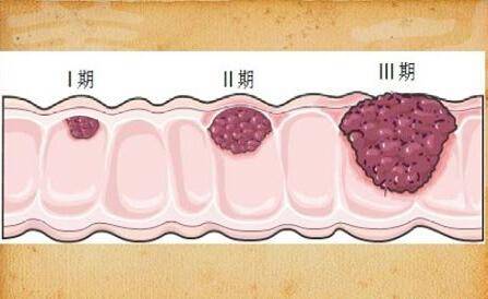 肠癌的大便图 粘液图片