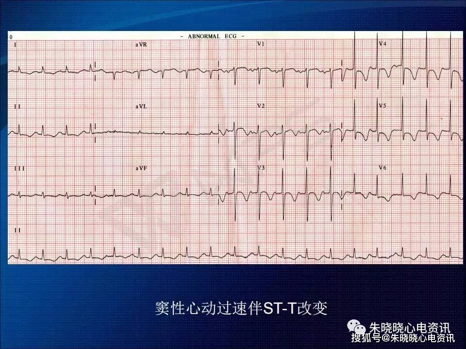 心電圖速度異常快慢堵亂ppt