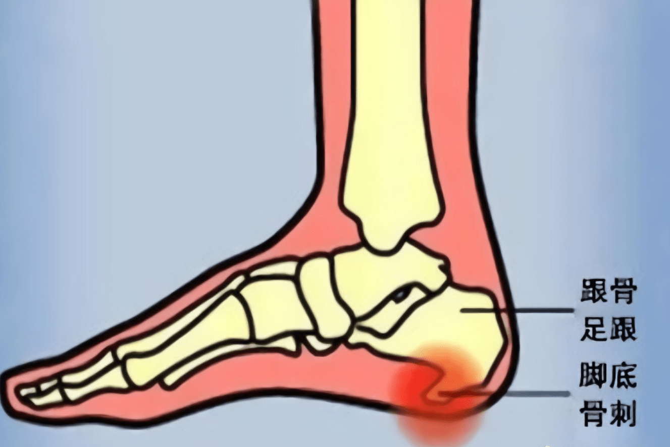 走路如 刀刺 女子每日行两万步 脚足跟竟长出一根 刺 王女士