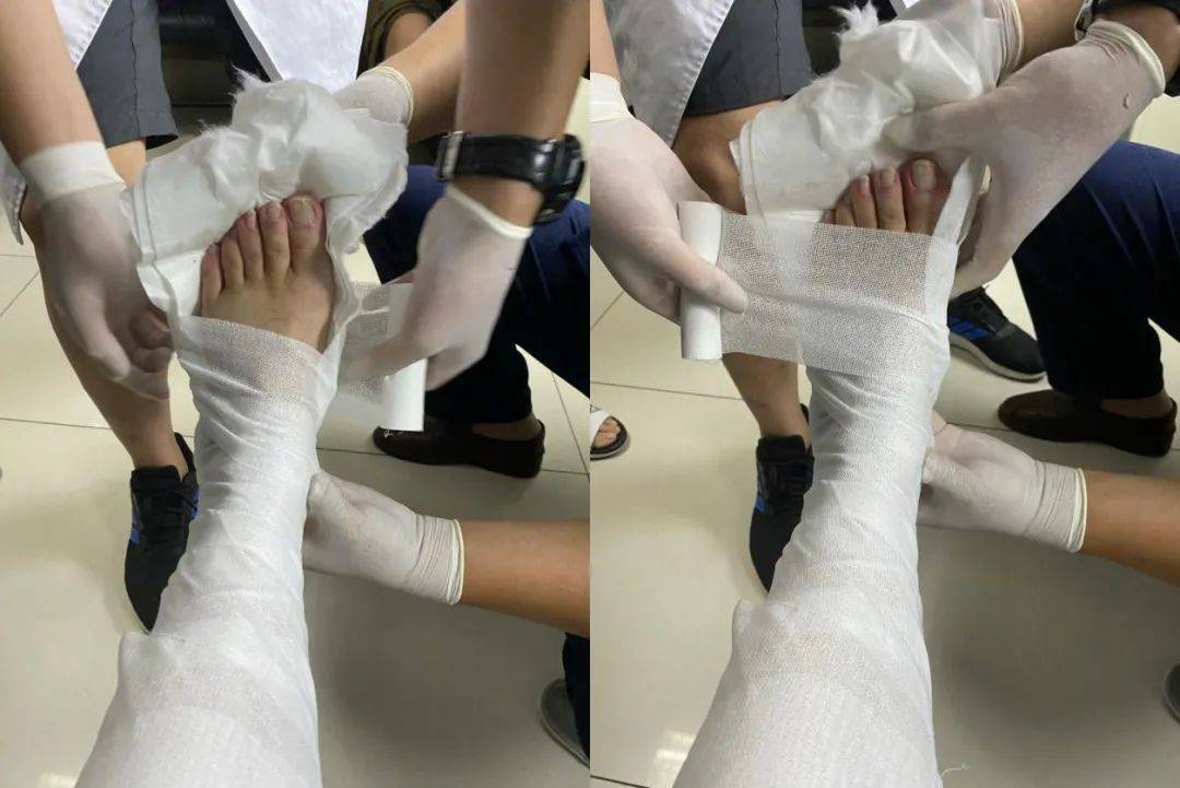 潘长江被800斤哈雷砸中,小腿粉碎性骨折细节曝光,坐轮椅拍戏