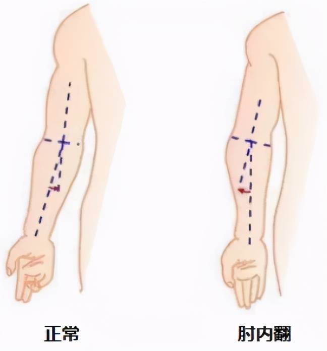 大多数轻度肘内翻畸形(内翻10度以内)患者除肘关节畸形外没有明显其他