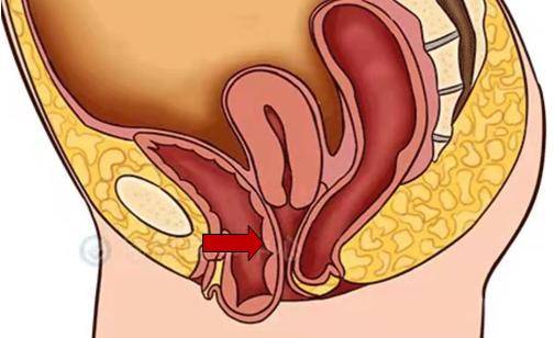 女性膀胱突出图片