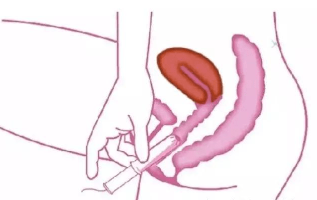 怎么收缩盆底肌肉 3c72953bd20341e3965f6d80714373c1.png