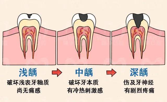 龋齿表现症状是不同的,根据龋齿破坏的程度,可分为浅龋,中龋和深龋