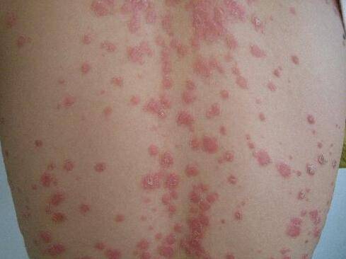 红斑狼疮是什么皮肤病?会传染吗?
