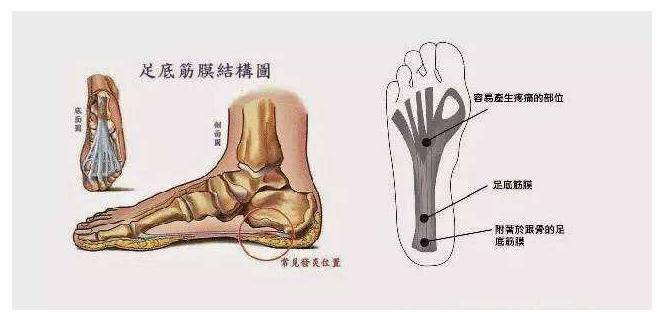 每踩一步都是煎熬 足底筋膜炎 懶人包