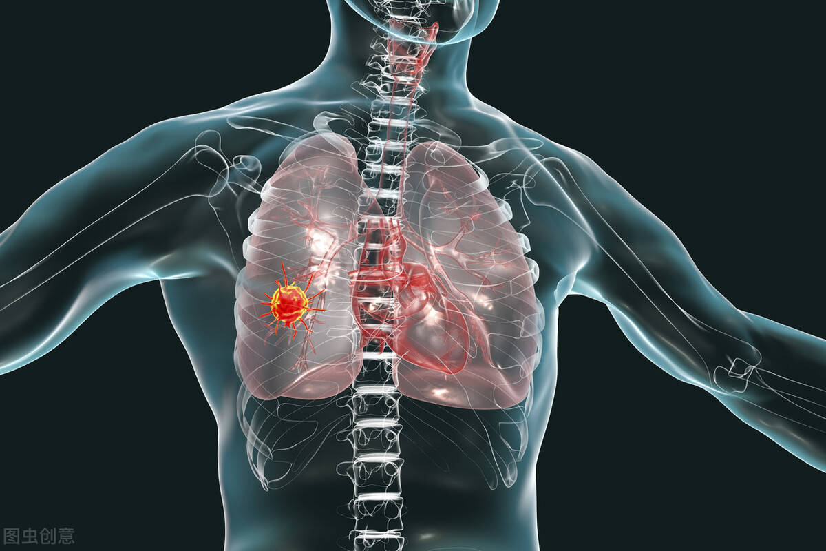 答:您好,很高興為您解答,大葉性肺炎(lobarpneumonia)主要是由