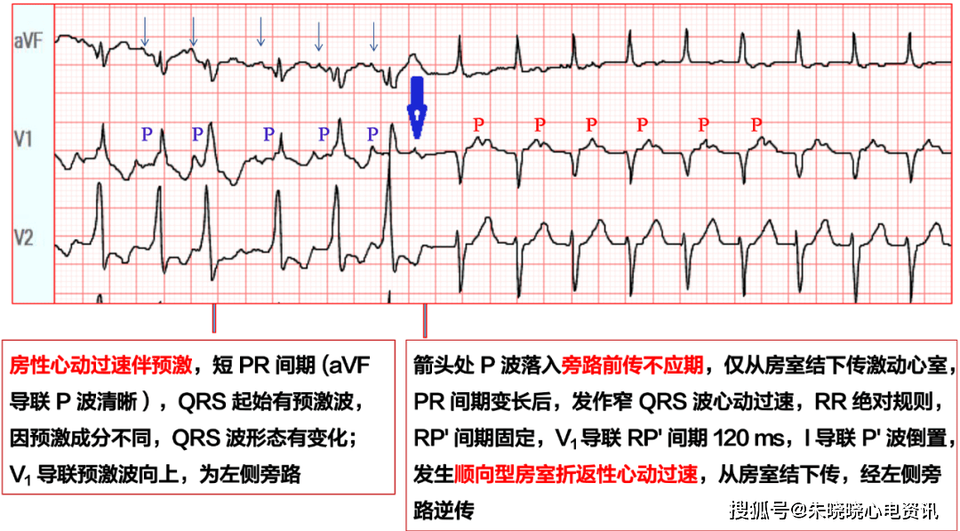 (点击查看大图 此图中,适时的心房激动遇到左侧旁路的前传不应期,则