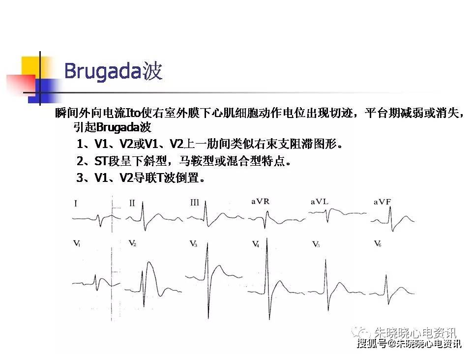 如何快速阅读一份心电图 1d9f4411e12649daa1f7040f0157e454.jpeg
