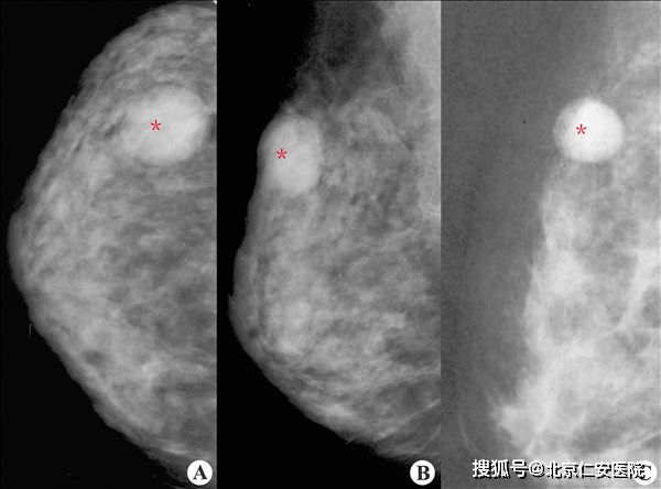 目前臨床上最主要應用的外科手術方法是乳腺癌改良根治術,通過保留胸