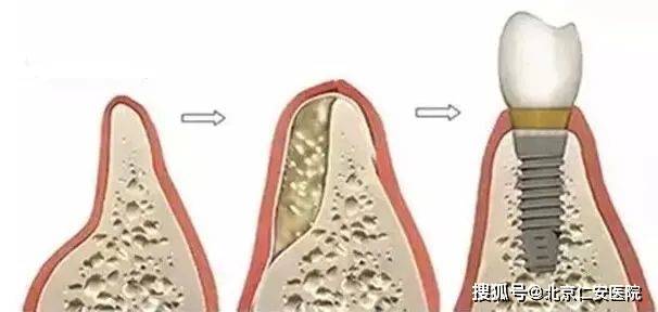 什么情况才需要种牙 b592d51ecfb445cd995d5936ab3b06fa.jpeg