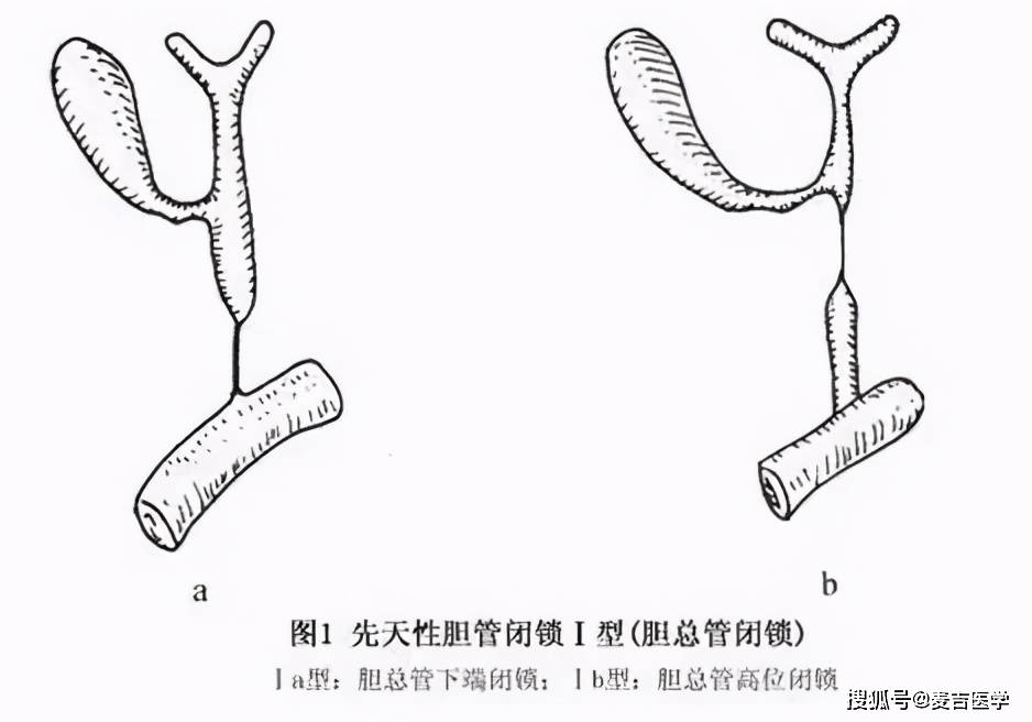 是一出生就有的吗?临床医生为你解答_胆管