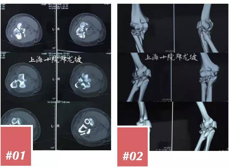 合併有冠狀突和橈骨小頭的粉碎骨折,既尺骨鷹嘴骨折後脫位型