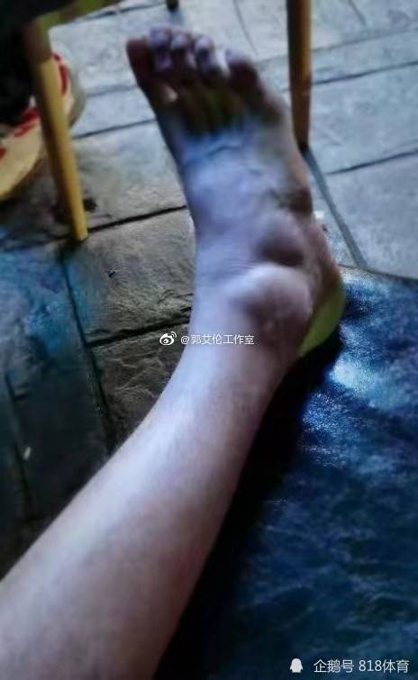 respect郭艾伦工作室晒他脚踝肿成包子手指红肿你对得起所有人