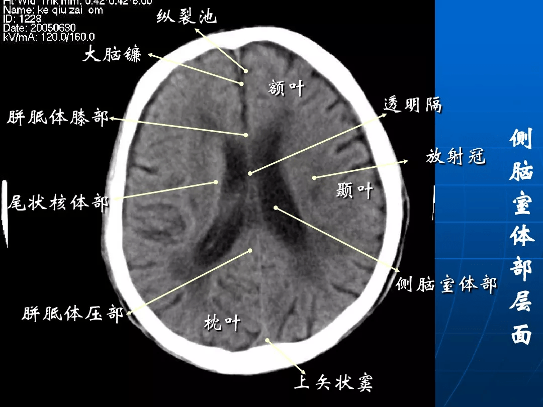 影像总结头颅ct基本知识与常见病变