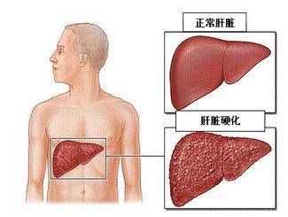 发烧肝癌的发热与癌热有关,是许多癌症的共同症状.
