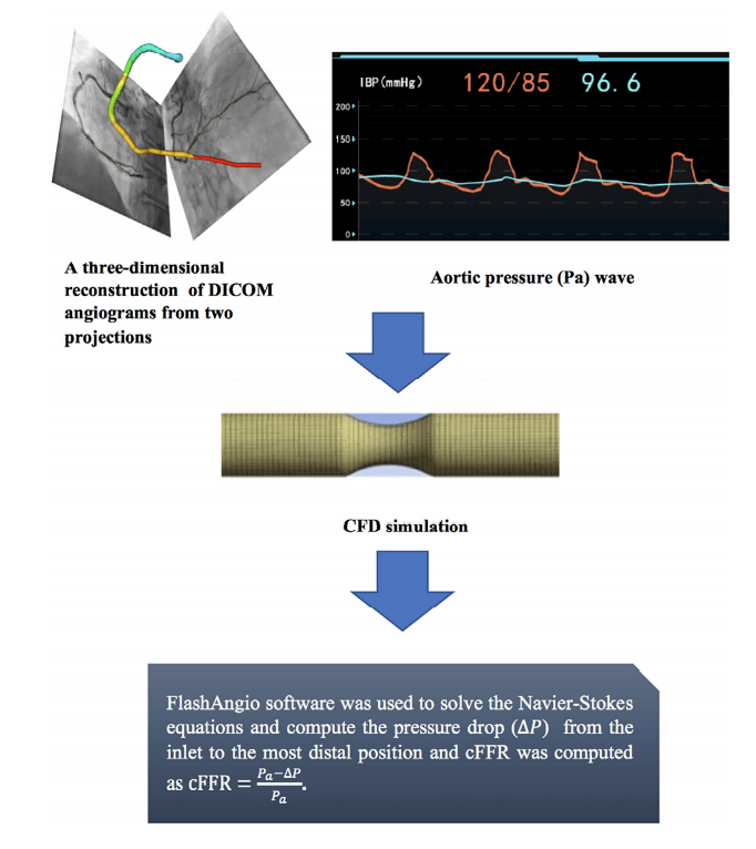 最新研究显示，基于造影的cFFR可改善冠脉功能学评估_caFFR