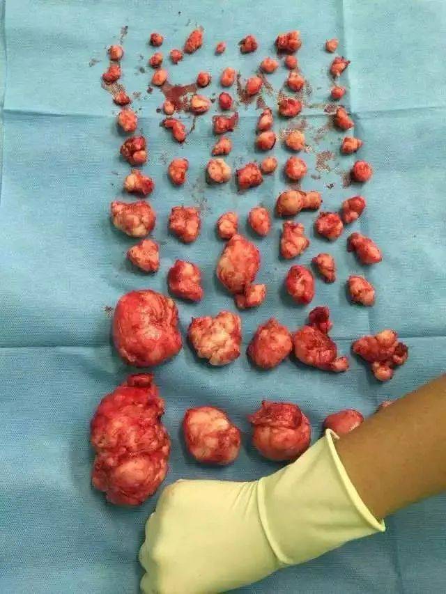 宫颈上长了肌瘤咋办呢?_手术