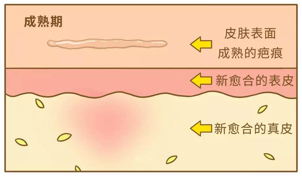 前者主要是溃疡,而后者形成的病理性瘢痕主要有疤痕疙瘩和增生性疤痕