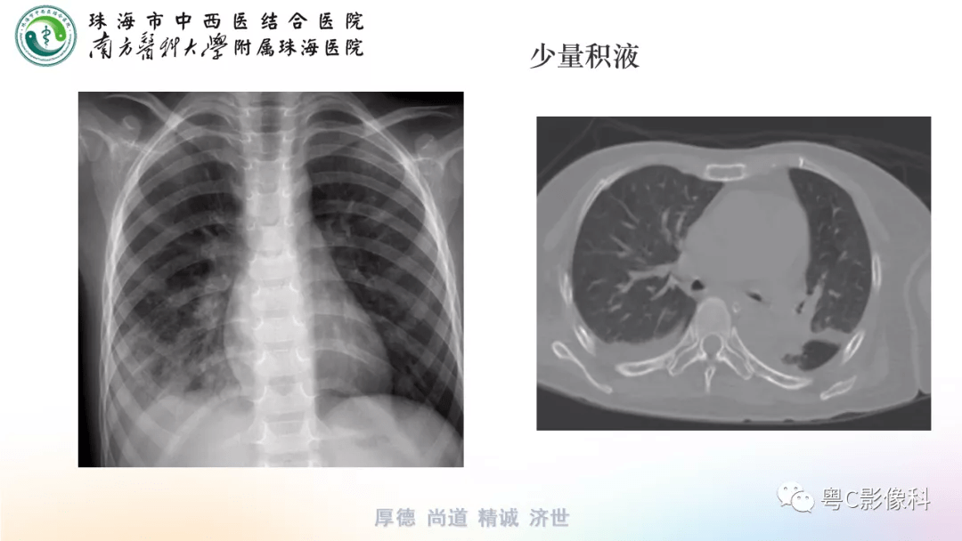 氣胸,胸腔積液,肋骨骨折影像表現