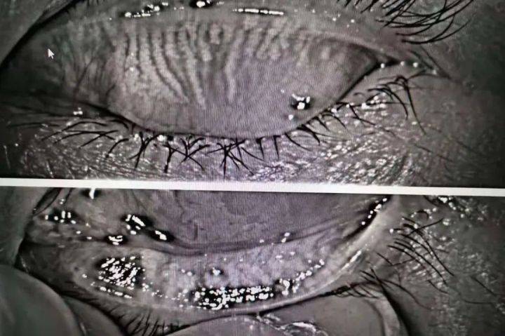 乾眼瞼板腺功能障礙mgd和強脈衝光治療ipl