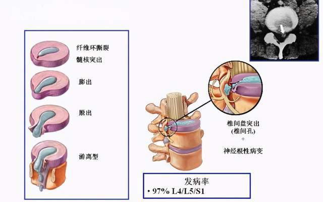 原創腰椎間盤突出並且出現鈣化,該如何治療呢?要手術嗎?