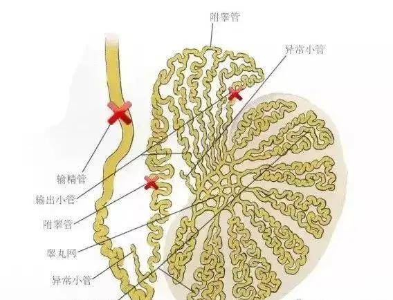 還有就是輸精管梗阻(如輸精管結紮),射精管梗阻,其中附睪梗阻最為常見