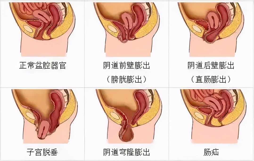 慌了子宮腸子膀胱都可能掉出來這七類女性需注意