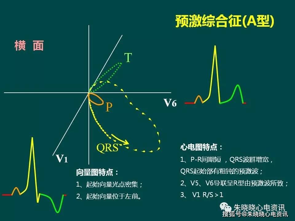 A型预激综合征图片