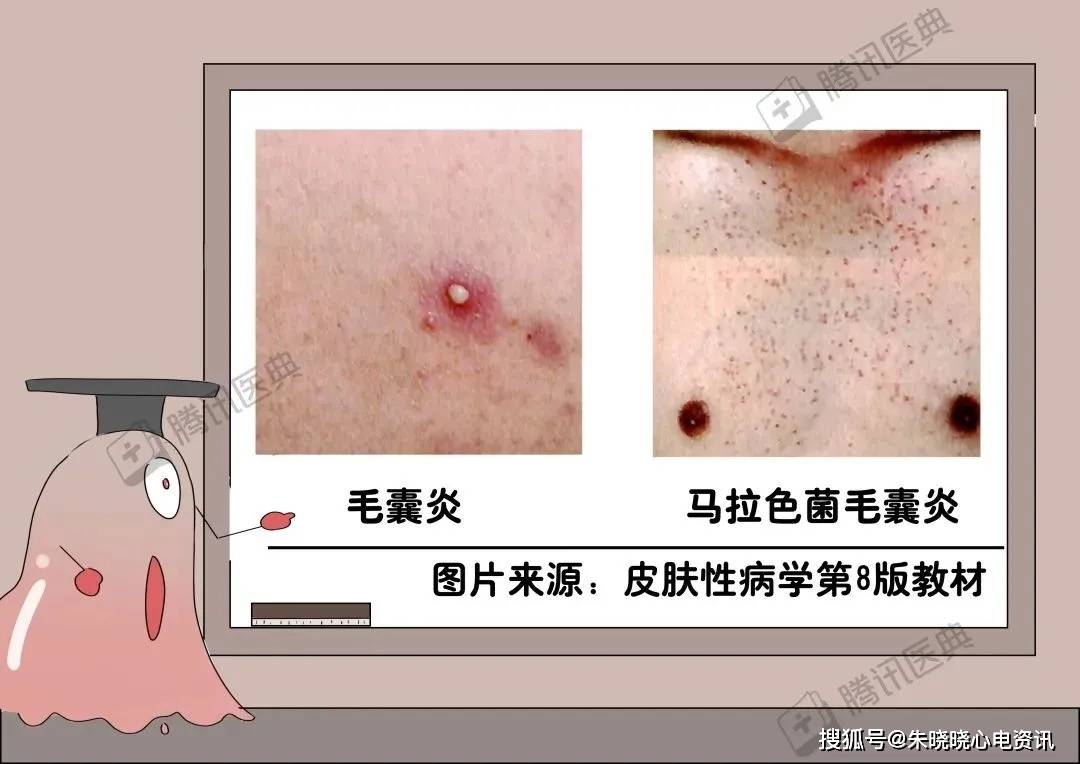 脓包周围有红晕,能挤出粉脂状的东西真菌也会导致毛囊炎,主要是糠秕