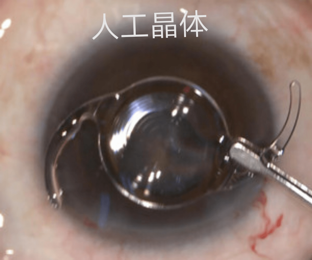 黄斑前膜等疾病,需要尽快手术治疗,需要进行玻璃体切除手术及人工晶体