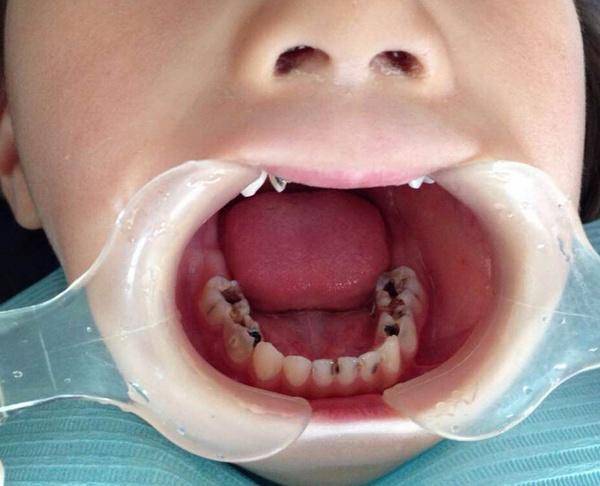 5岁宝宝从不吃糖每天坚持刷牙,却有蛀牙?牙医点醒了家长