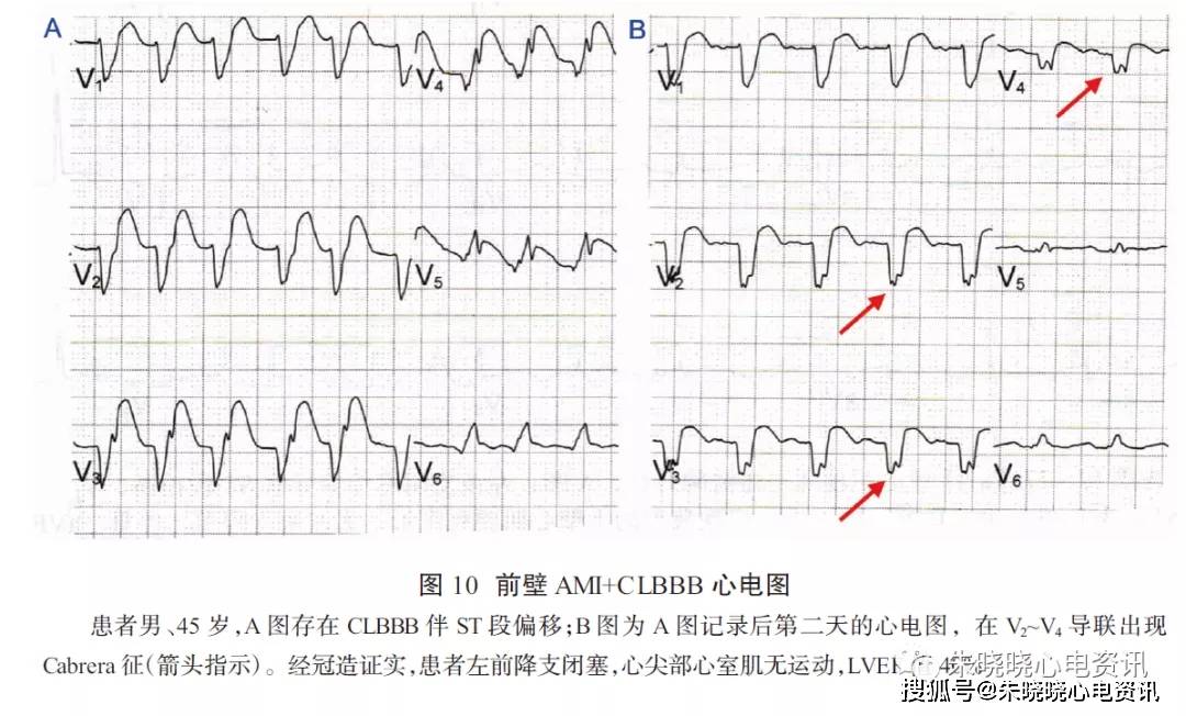 一文總結clbbbami的心電圖診斷值得一看