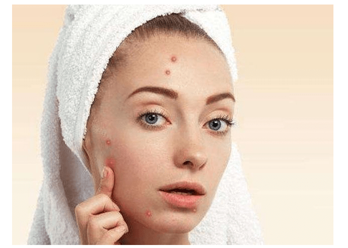 怎么做才能不长痘痘 afc9b23b33cd477db8d1b3257a38488d.png