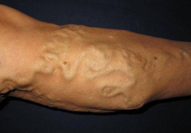 啥叫静脉石 682b049a2fe44ba69ce0c53484eaf787.jpeg