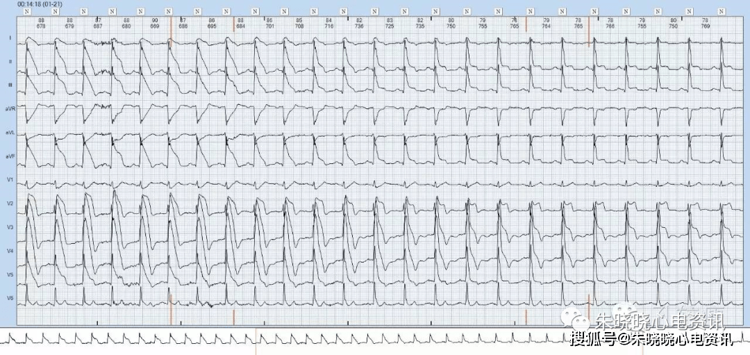心肌梗死从红旗飘飘到墓碑留名全过程