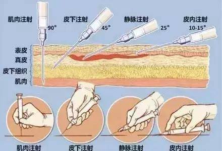 【护士必看】一文读懂:皮内注射,皮下注射,肌肉注射,静脉注射