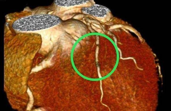 冠心病图片 真实图片