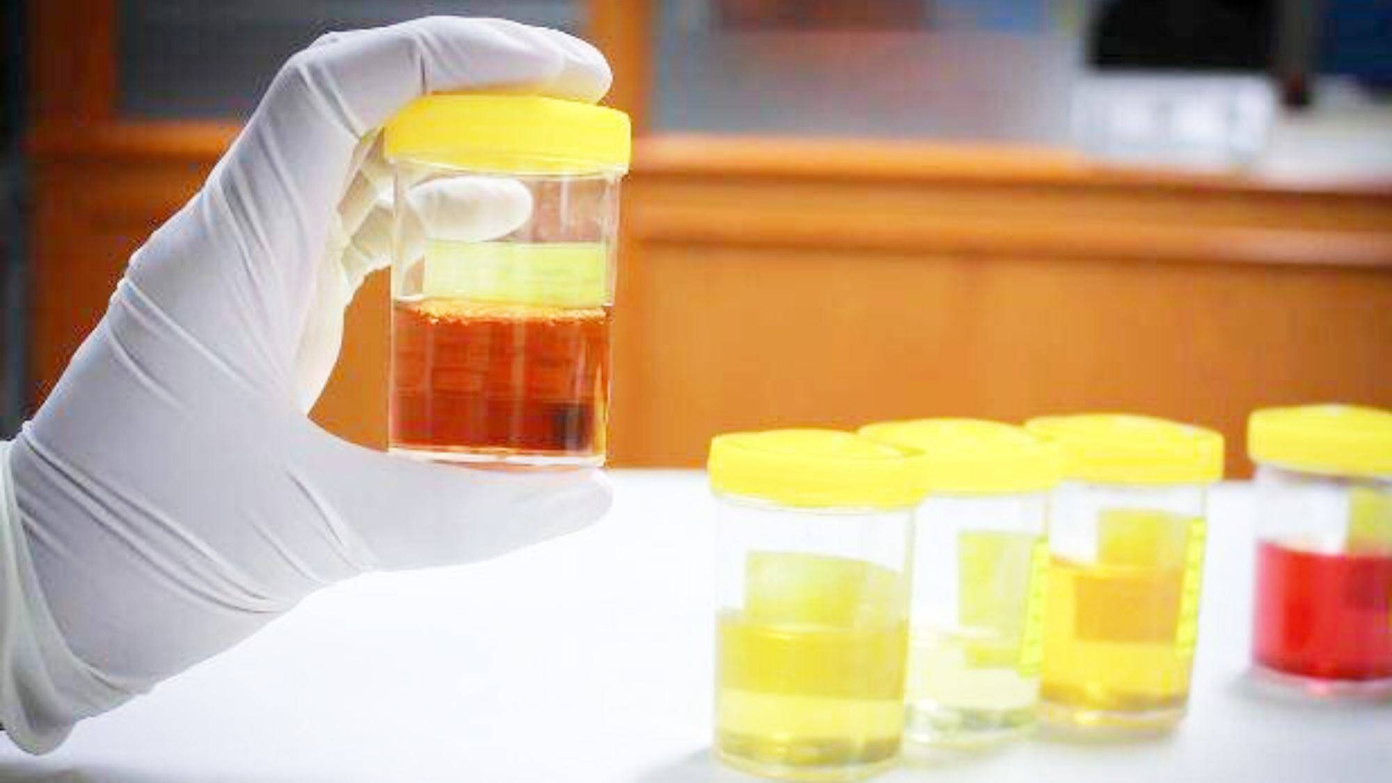 喝水多,或者喝水少,出汗多的情况的话,出现尿液的突然增多或者减少,则