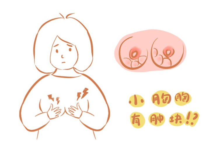 乳腺癌变前身体往往会出现4个症状若发现1个需及早就医检查