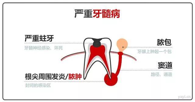 牙龈长脓包?请做到“二不一要”!