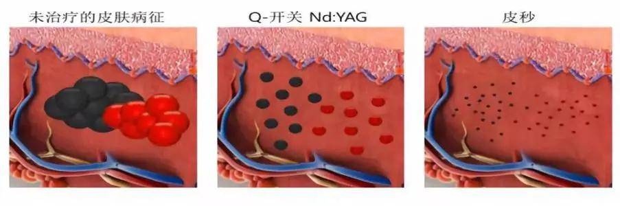 血管|光子嫩肤、皮秒、水光针怎么选？看完你就知道了